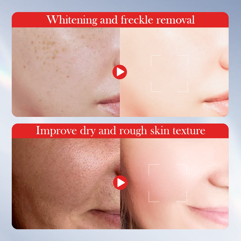 Kojic Acid Whitening and Anti-freckle Facial Cream