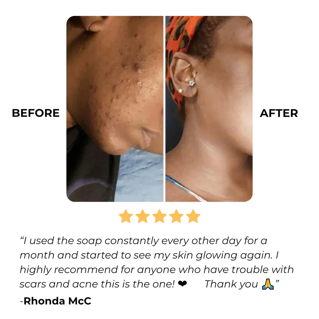 Alojalife-Turmeric Lemon Kojic Acid Soap-Yellow Colour-Customer Feedback Photos